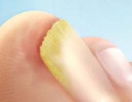 milyen tabletta ital gomba ellen a körmökön kiesik a köröm gombás használati útmutató